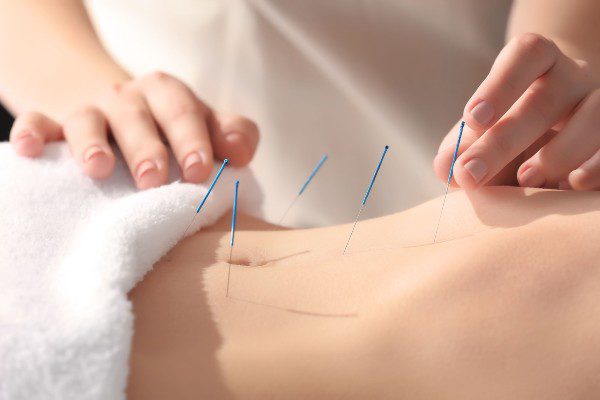 Fertility Acupuncture