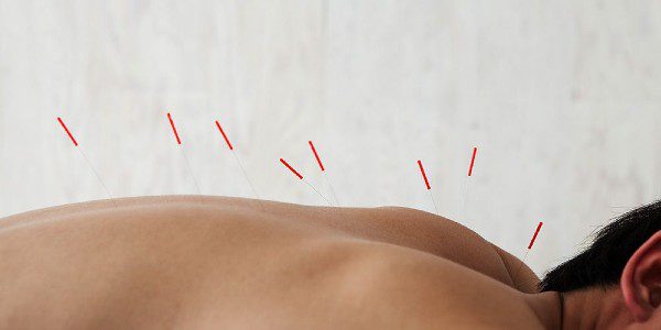 Acupuncture Needles on upper back