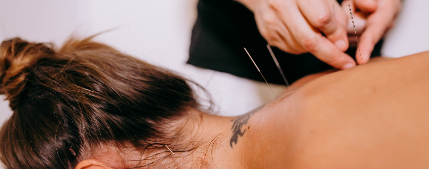 Acupuncture Needles On Upper Back