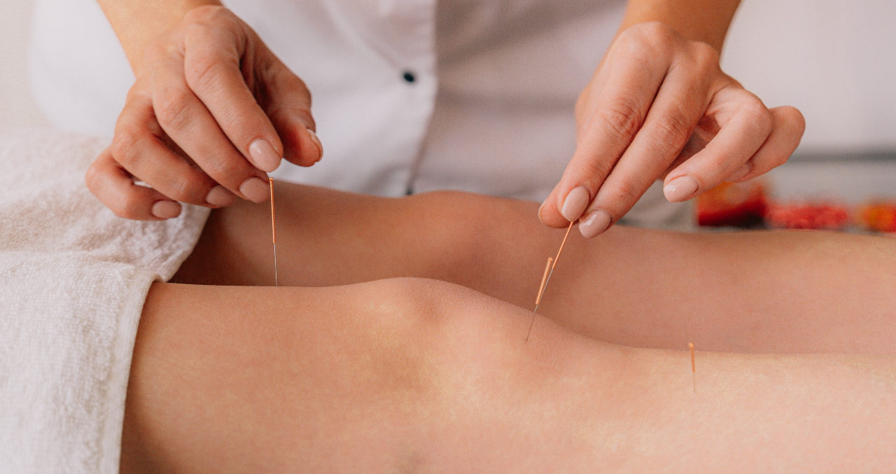 Acupuncture needles in ladies legs