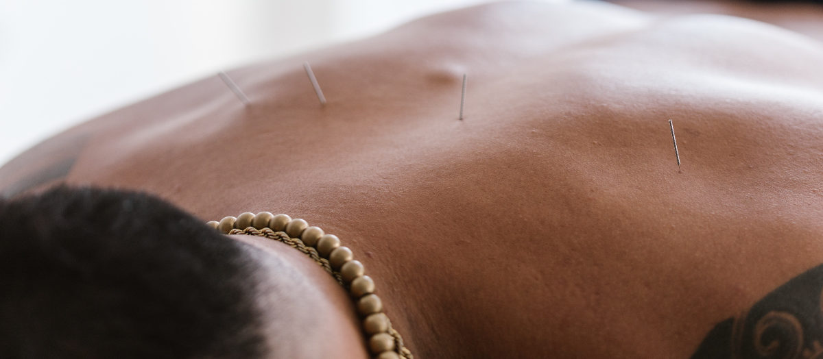 Acupuncture On Mans Back